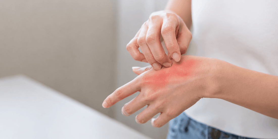 Person scratching an itchy red rash on the back of their hand, showing skin irritation and discomfort.