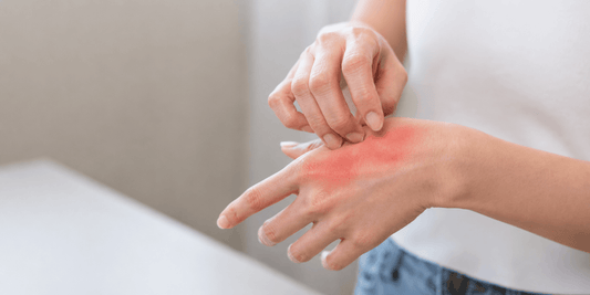 Person scratching an itchy red rash on the back of their hand, showing skin irritation and discomfort.