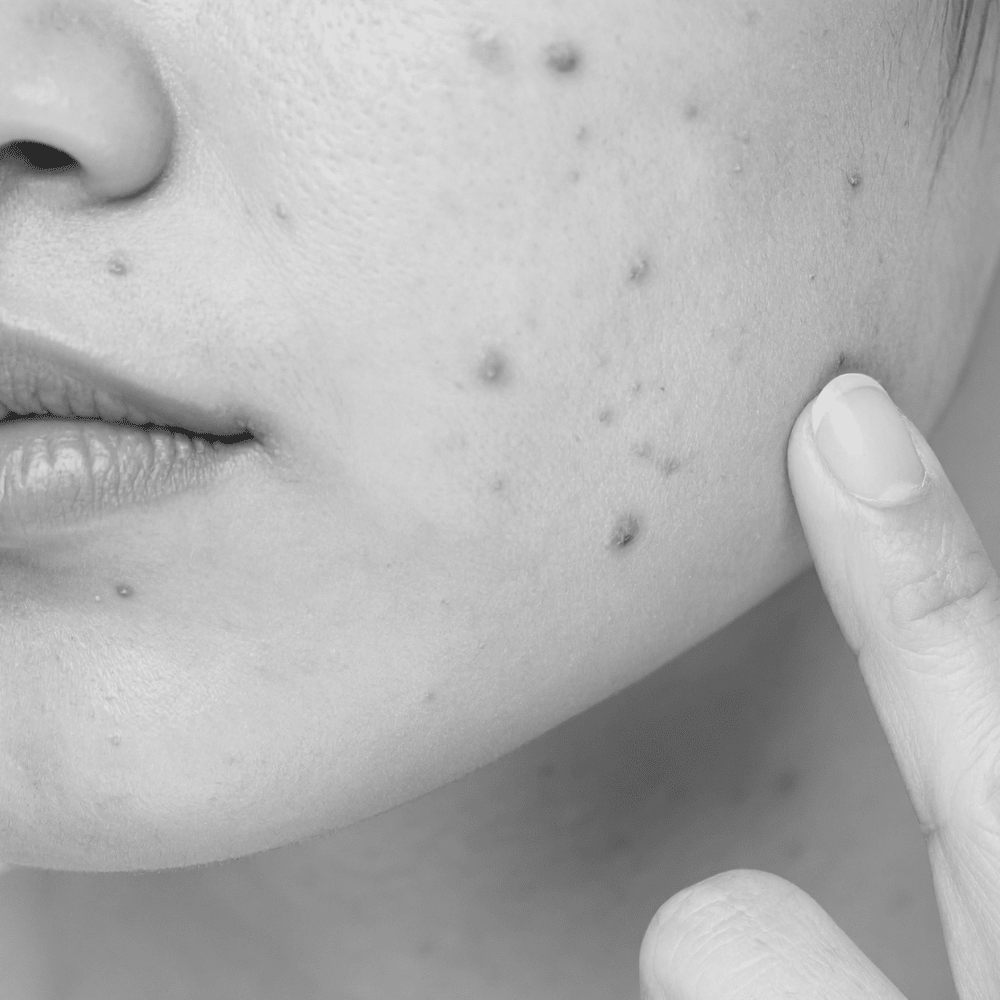 Acne - bhisajyam.com