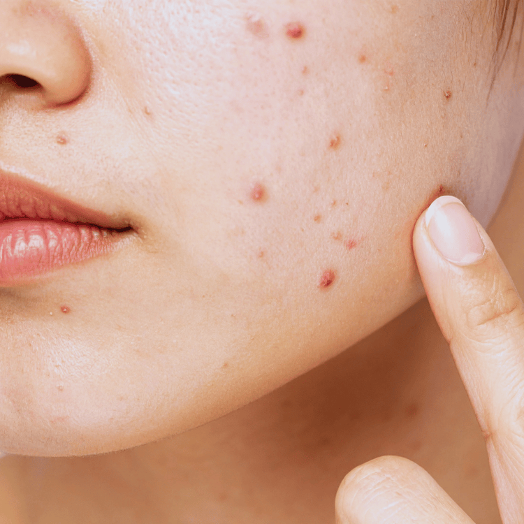 Acne prone skin with breakouts requiring natural essential oil skincare treatment