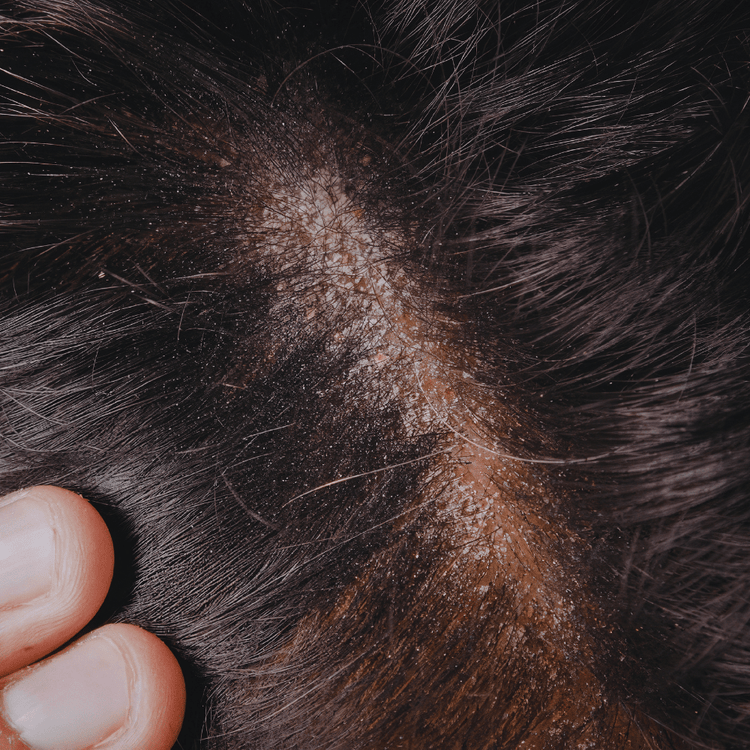Dandruff scalp condition showing flakes on hair for hair fall and scalp treatment using natural oils